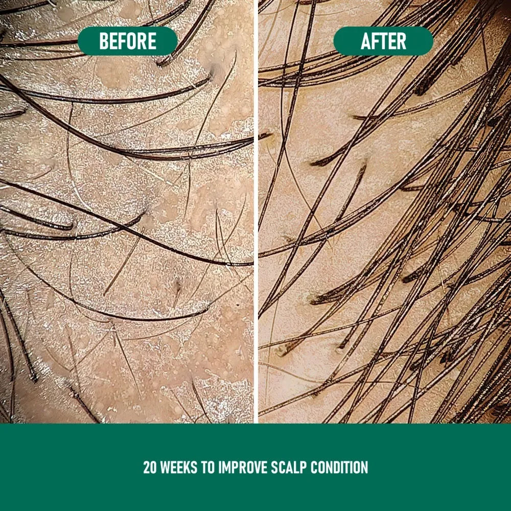 CH004 Minoxidil 5% anti-hair loss mousse foam canister for hair regrowth treatment