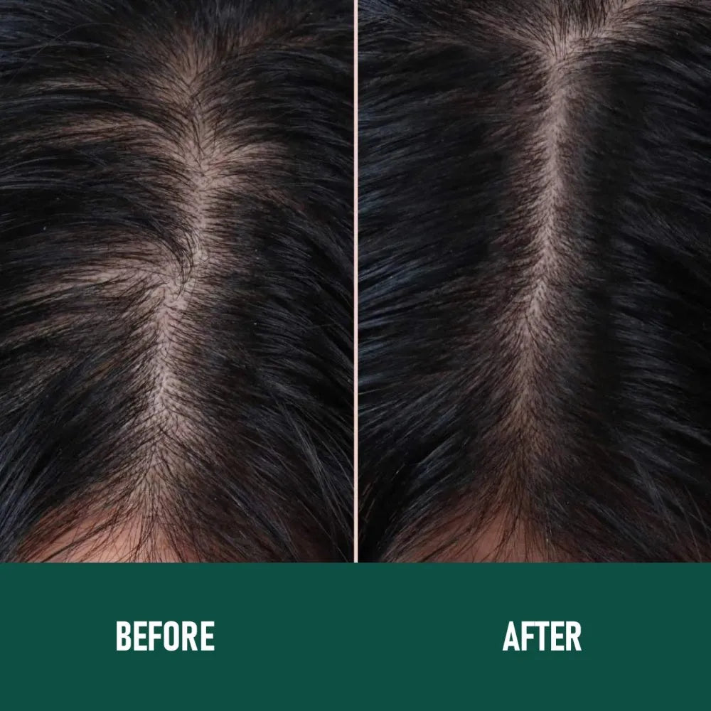 CH004 Minoxidil 5% anti-hair loss mousse foam canister for hair regrowth treatment