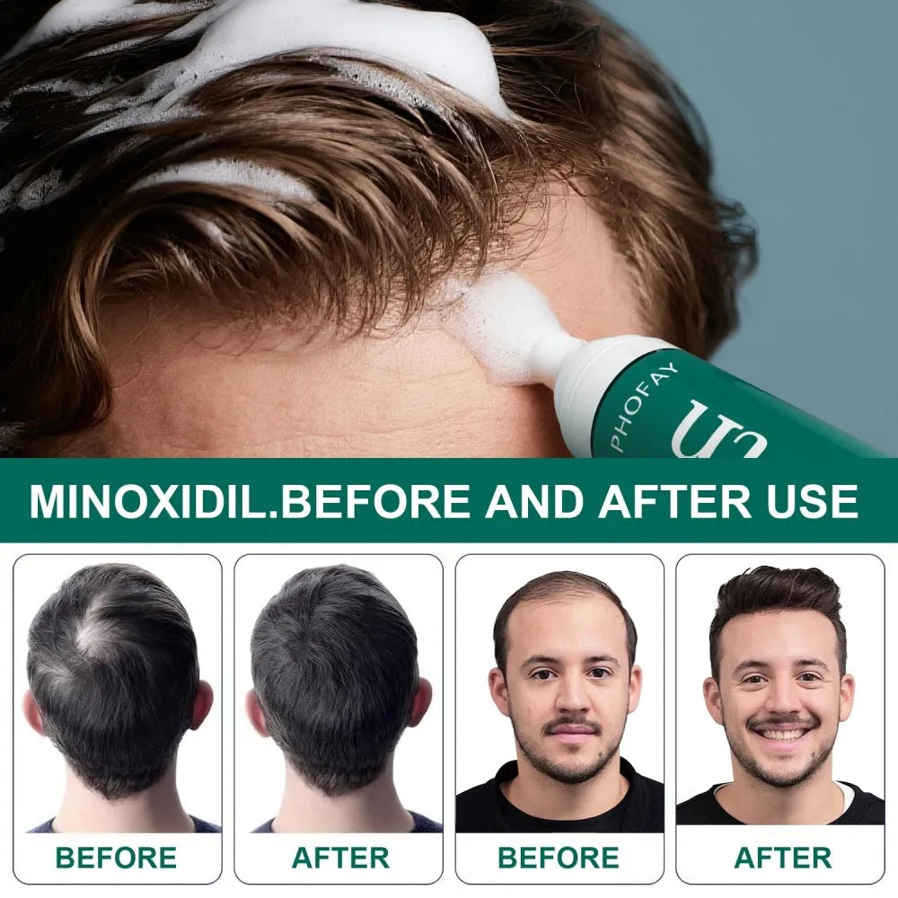 CH004 Minoxidil 5% anti-hair loss mousse foam canister for hair regrowth treatment