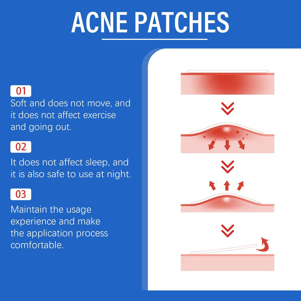 Pack of 216 hydrocolloid acne patches for facial blemish care with tea tree oil and vitamin E.