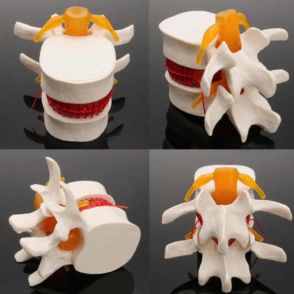 White PVC lumbar intervertebral disc demonstration model for medical anatomy teaching
